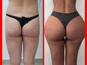 Buttocks Enlargement Oil To Increase Buttock Size Butt Lift 1